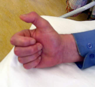 A picture of Alan's hand