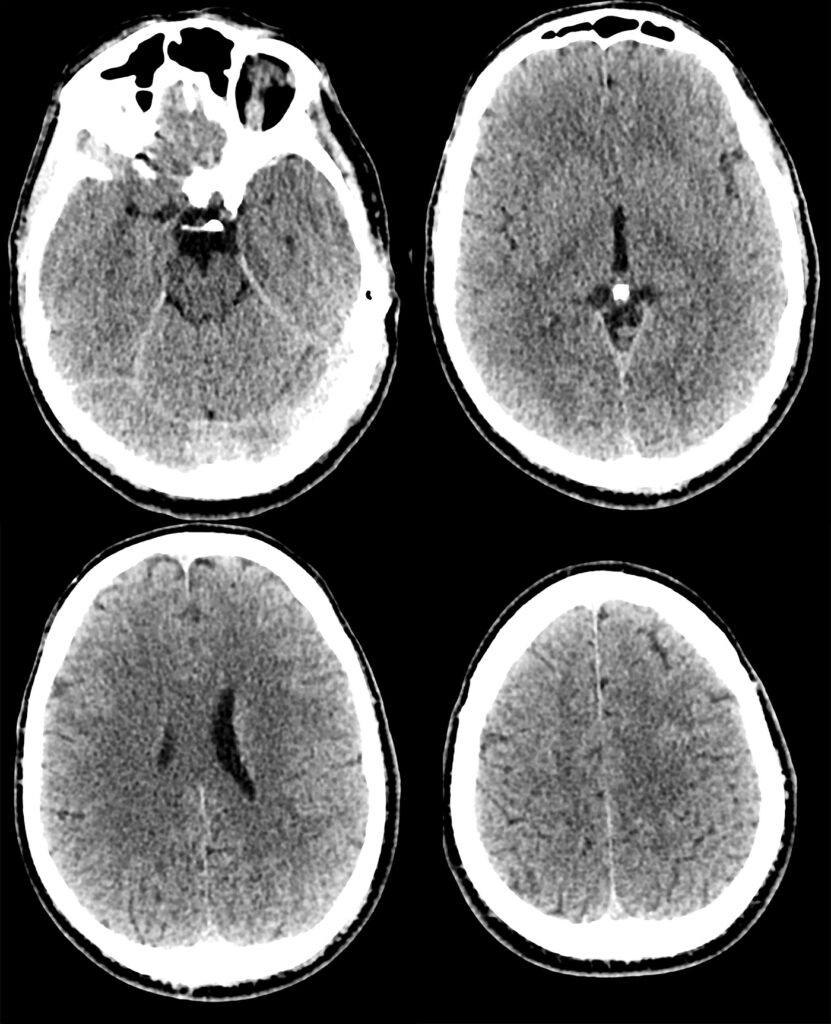 12: Non contrast CT head - CHSS eLearning