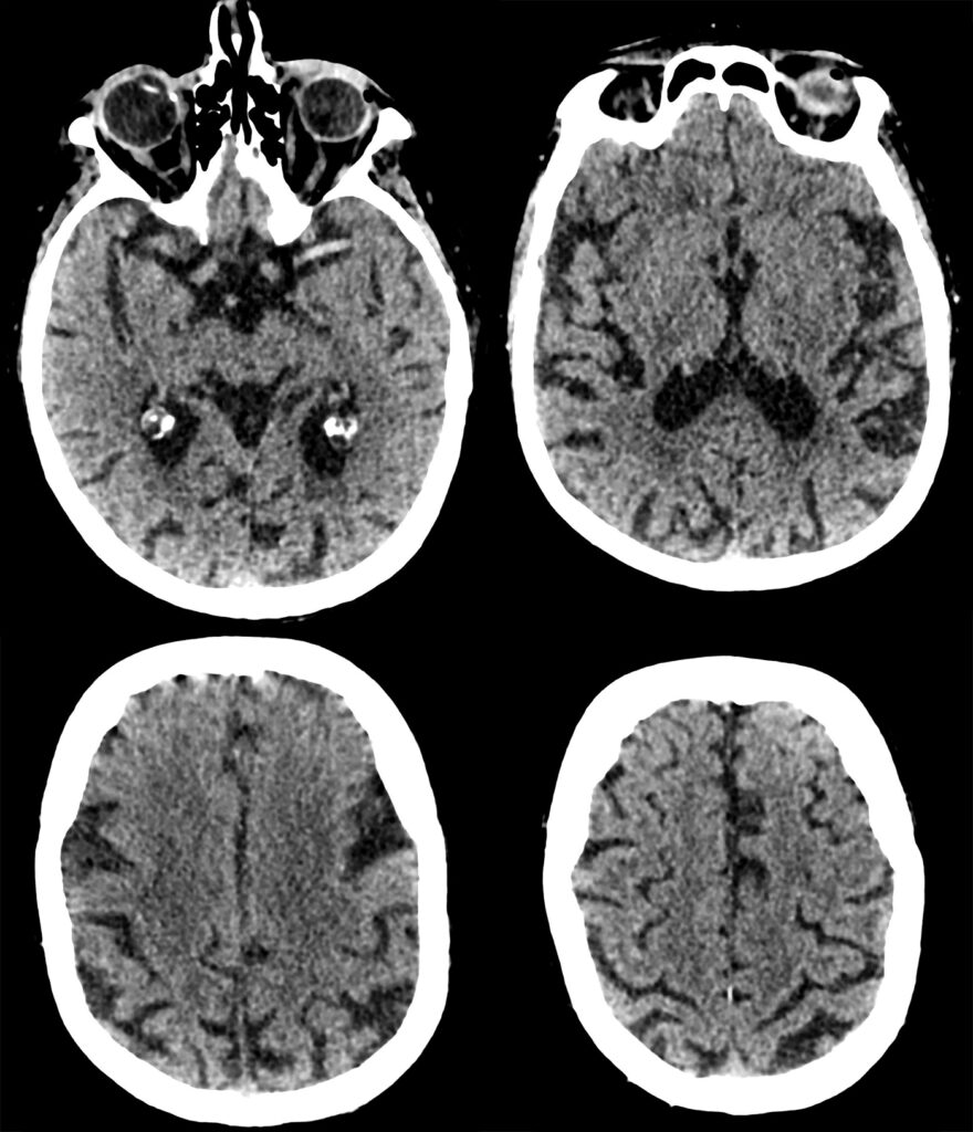 Hyperacute stroke decision making for clinicians Archives - Page 3 of ...